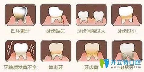 牙貼面能修復哪些問題牙齒