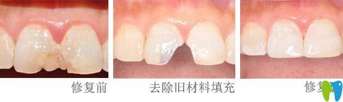 楊瑾瑛醫(yī)生做牙齒修復案例
