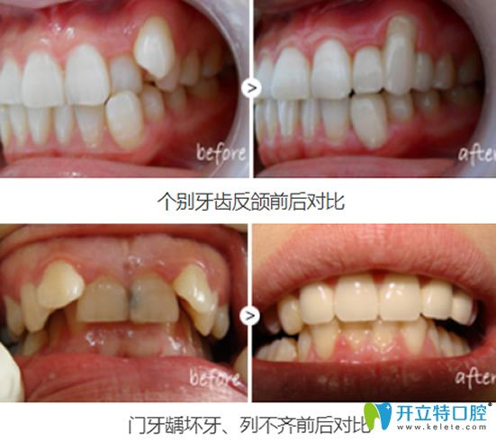 重慶牙博士口腔葉金平牙齒修復(fù)案例對(duì)比圖