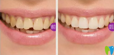 嵌體修復前后對比