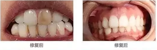 我們的牙齒為什么這么黃？新鄉(xiāng)貝特口腔教你來(lái)變白