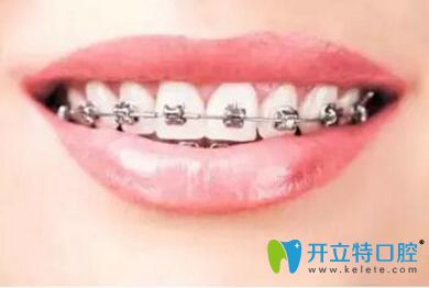 舟山健寧牙齒矯正器種類(lèi)有哪些？牙齒矯正期間如何刷牙？