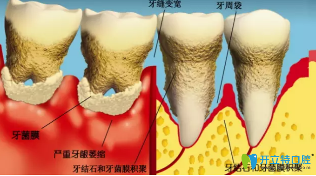 導致牙周病的原因