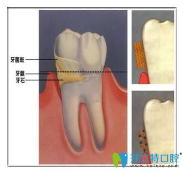 牙結(jié)石的危害你知道嗎？告別牙結(jié)石可以用這7種方法