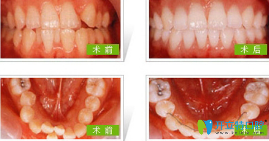 成人可以矯正牙齒嗎？成人牙齒矯正有哪些方法？