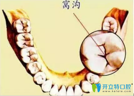 石家莊三博口腔李磊做客FM98.1廣播電臺(tái)解說(shuō)窩溝封閉