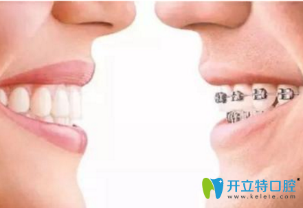 兒童用隱形牙套和傳統(tǒng)牙套哪個(gè)效果好？