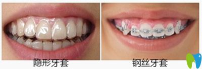 阜陽貝得口腔牙齒矯正案例 阜陽貝得口腔牙齒矯正案例