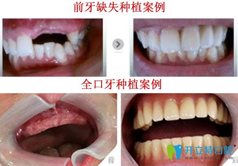 晉中潤芽口腔<!--<i data=20240703-sp></i>-->種植牙好嗎？看<!--<i data=20240703-sp></i>-->種植牙案例對(duì)比圖