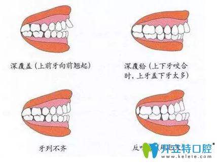 徐州博愛(ài)口腔暑期正畸優(yōu)惠開(kāi)始啦