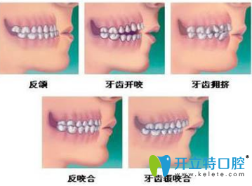 兒童矯正牙齒有哪幾個年齡段？有幾種矯牙齒的方法？