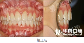 在濰坊華貝口腔做了牙齒矯正，恢復(fù)后我擺脫了齙牙妹