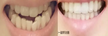 牙齒矯正要多久？90后美女用10個(gè)月完成牙齒正畸的真實(shí)經(jīng)歷