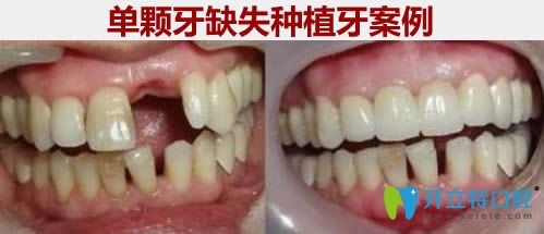 單顆牙缺失種植牙前后對比效果圖