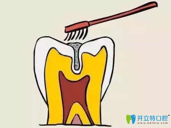 孩子幾歲做窩溝封閉合適？做完窩溝封閉后還會(huì)長蛀牙嗎？