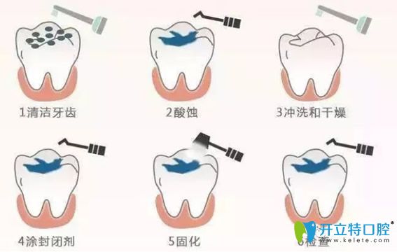窩溝封閉的操作流程