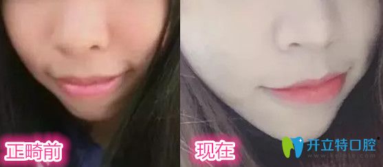 讓<!--<i data=20240703-sp></i>-->口腔醫(yī)生做牙齒正畸前后對比照片一覽