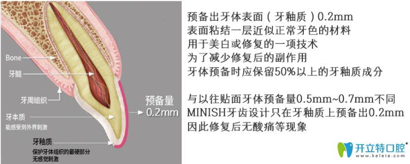 較少磨牙的minish牙齒貼面技術(shù)實現(xiàn)牙齒美白