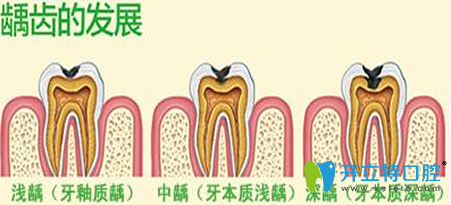 兒童齲齒怎么治療多少錢？齲齒治療預防方法及費用大全
