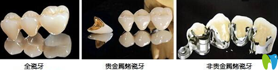 烤瓷牙哪種好多少錢一顆？分享烤瓷牙的種類和價格表