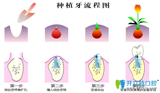 種植牙好不好？公布種植牙種類和2025全新價格表