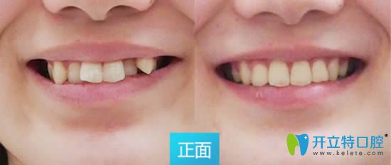 深圳拜爾口腔張?jiān)贩坚t(yī)生成年人虎牙矯正前后對(duì)比效果