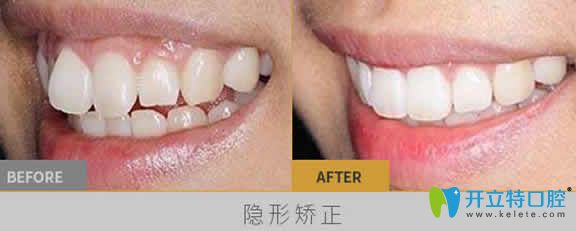 長沙雅美口腔劉景醫(yī)生隱形牙齒矯正案例效果圖