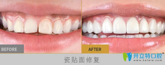 長沙雅美口腔劉景牙齒瓷貼面修復效果對比圖