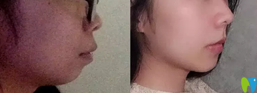 用我在長(zhǎng)沙科爾雅臉型變化圖來驗(yàn)證骨性齙牙矯正有效果嗎