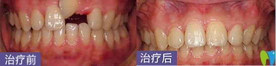 深圳烤瓷牙哪家好？鵬程口腔牙齒修復案例來嘍