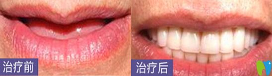 深圳哪家種植牙好？看深圳鵬程口腔種植牙案例