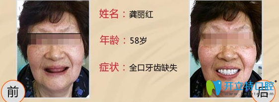 深圳格倫菲爾口腔林帆種植牙怎么樣？案例來啦