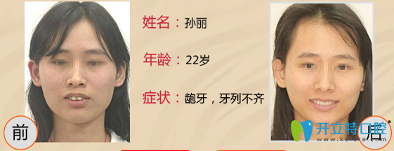 王亞東22歲女性齙牙矯正案例前后效果對(duì)比圖