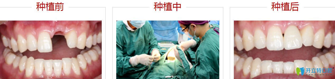 深圳哪里種牙比較好？來看格倫菲爾種植牙案例