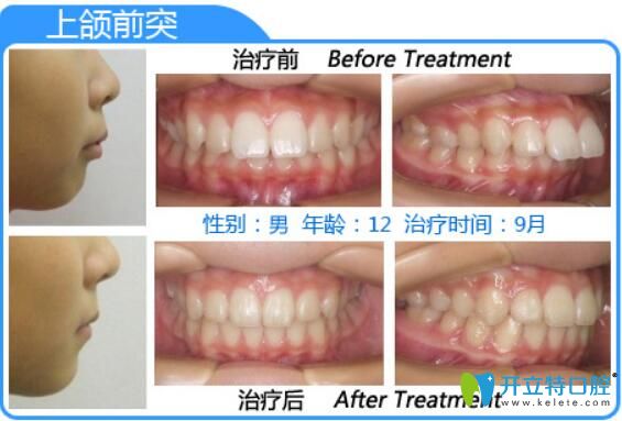 深圳格倫菲爾口腔朱明璋齙牙矯正案例前后對比圖