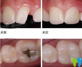 重慶牙博士口腔補(bǔ)牙前后對比圖
