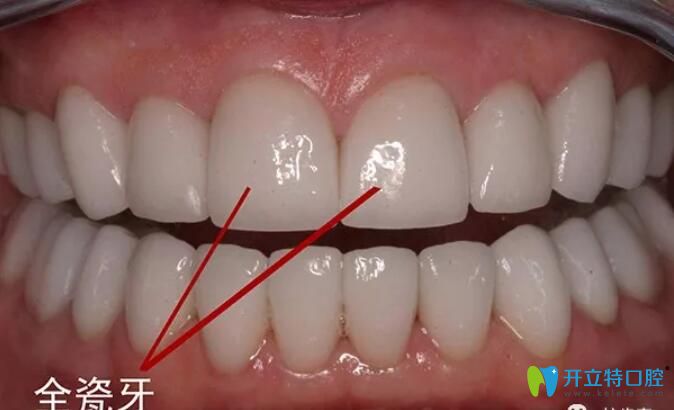 全瓷牙產(chǎn)地影響價(jià)格的，來(lái)看深圳進(jìn)口/國(guó)產(chǎn)全瓷牙多少錢(qián)一顆