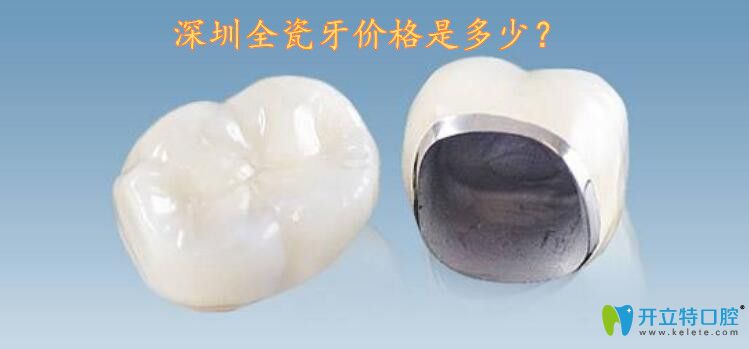 深圳全瓷牙價(jià)格是多少呢