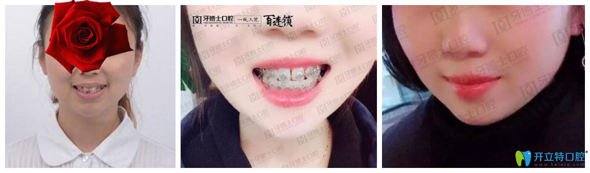 重慶成佳牙博士怎么樣，坑人嗎？看牙博士口腔醫(yī)生矯正真人案例