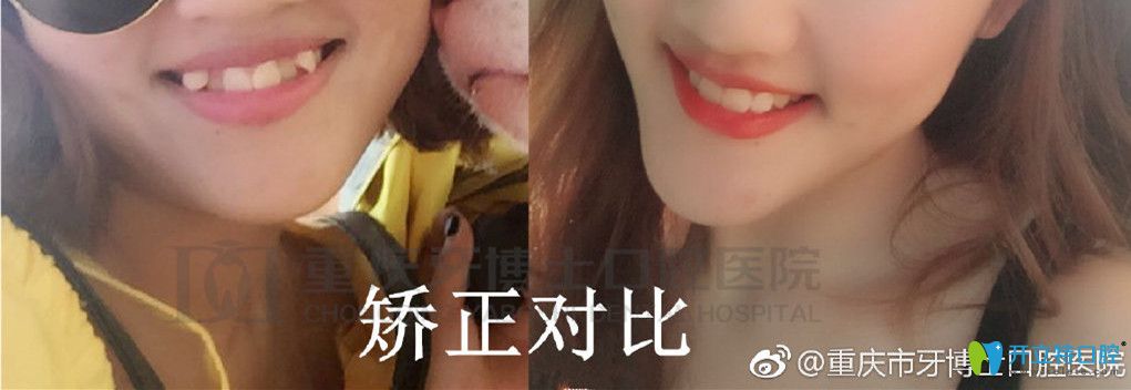 重慶牙博士正畸對(duì)比圖