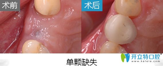 北京美萊口腔于英院長即刻種植牙案例