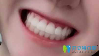 我在北京美萊口腔做隱形牙齒矯正500天牙套畢業(yè)