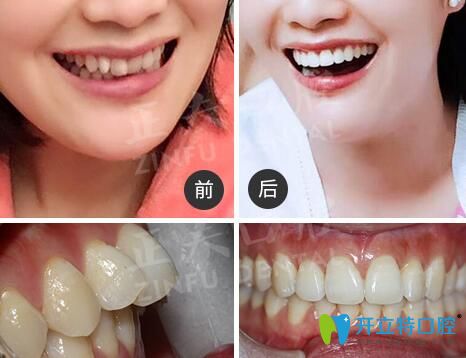 深圳正夫口腔正畸怎么樣？看多組正夫口腔牙齒矯正評價