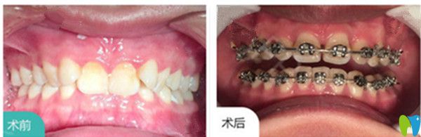 吉林愛齒口腔耿悅牙齒矯正對(duì)比圖