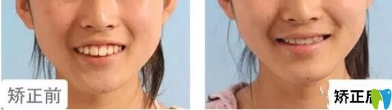 格倫菲爾口腔水平如何？14女孩上牙前突矯正<span style=