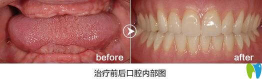 格倫菲爾口腔怎么樣？老年人全口牙缺失種植<span style=