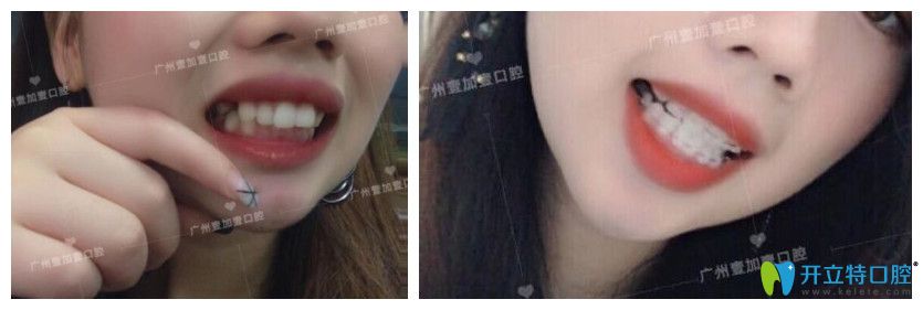 廣州壹加壹齙牙、牙齒擁擠不齊矯正案例效果前后對(duì)比照片