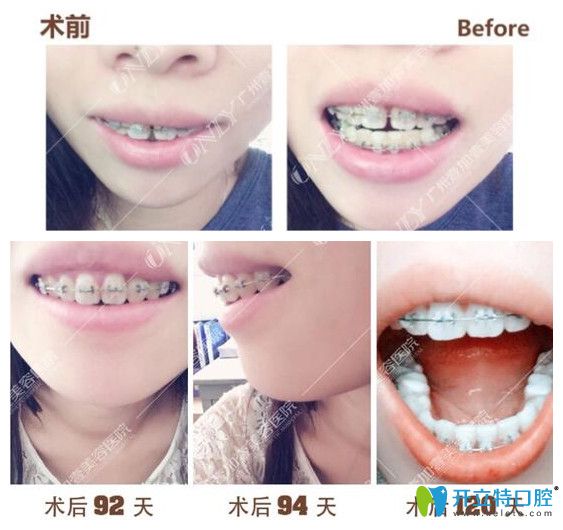 壹加壹齙牙，門牙縫隙矯正過程中牙齒變化圖