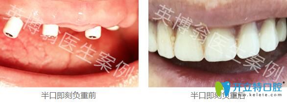 看我找上海英博口腔翁弘元花3999元做的韓國(guó)種植牙效果怎樣