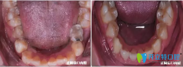 我兒子下牙頜內(nèi)矯正前后的效果